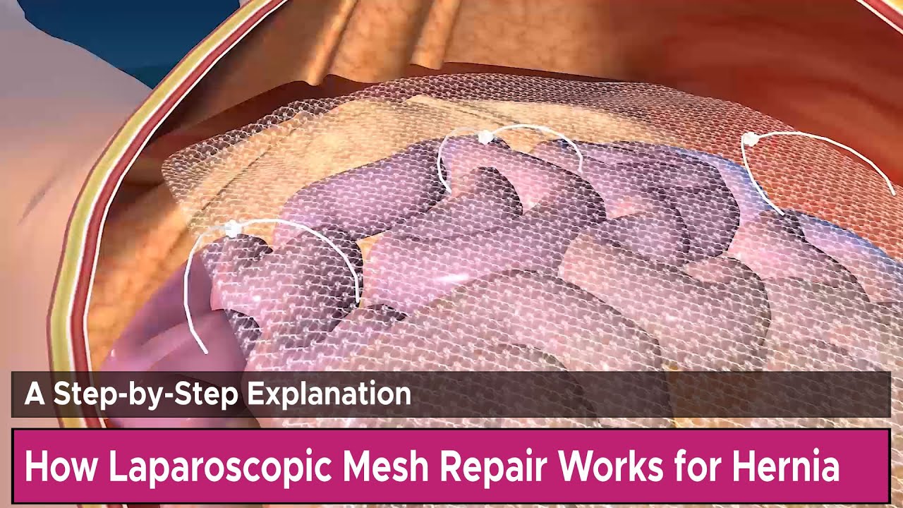Bard Hernia Mesh Complications