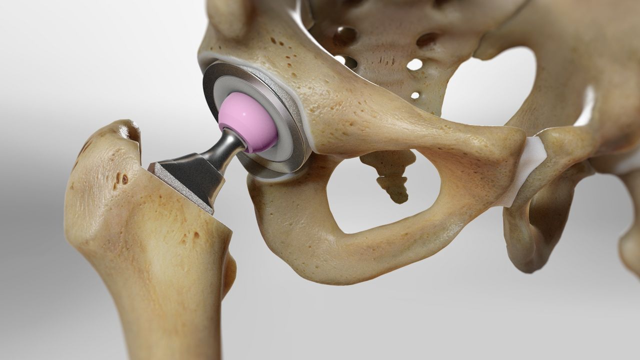 Defective Orthopedic Hip Replacements