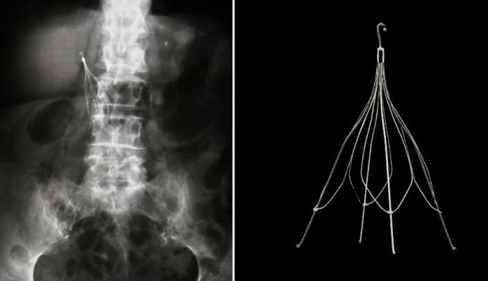 IVC Filter Complications