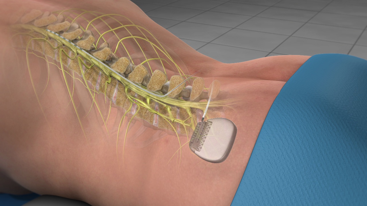 Spinal Cord Stimulator Complications